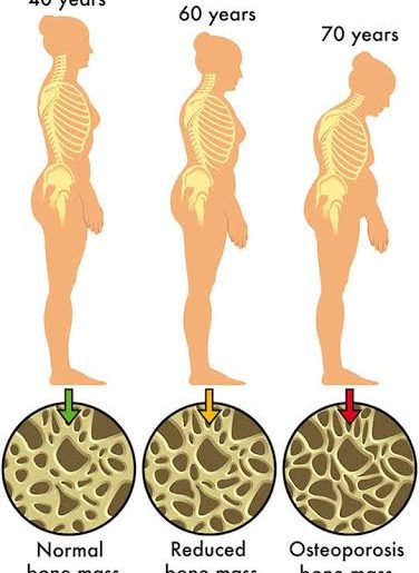 OSTEOPOROSIS