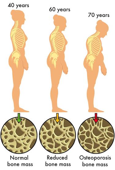 OSTEOPOROSIS